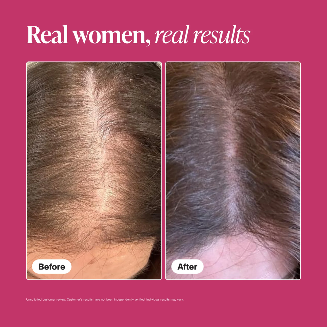 Bare Anatomy Advanced Hair Growth Serum | 3% Redensyl + 4% Anagain + 3% Baicapil + 1% Capilia Longa | Clinically Proven to Reduce Hair Fall & Boost Regrowth