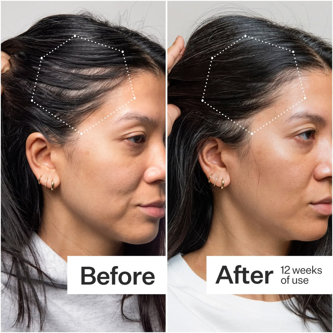 Tgideas Rosemary Amino Acid Shampoo – Strengthens Hair Roots, Promotes Hair Growth, Reduces Hair Fall – Deep Cleansing, Nourishing & Safe – For Dandruff, Oily Scalp, Dry & Frizzy Hair