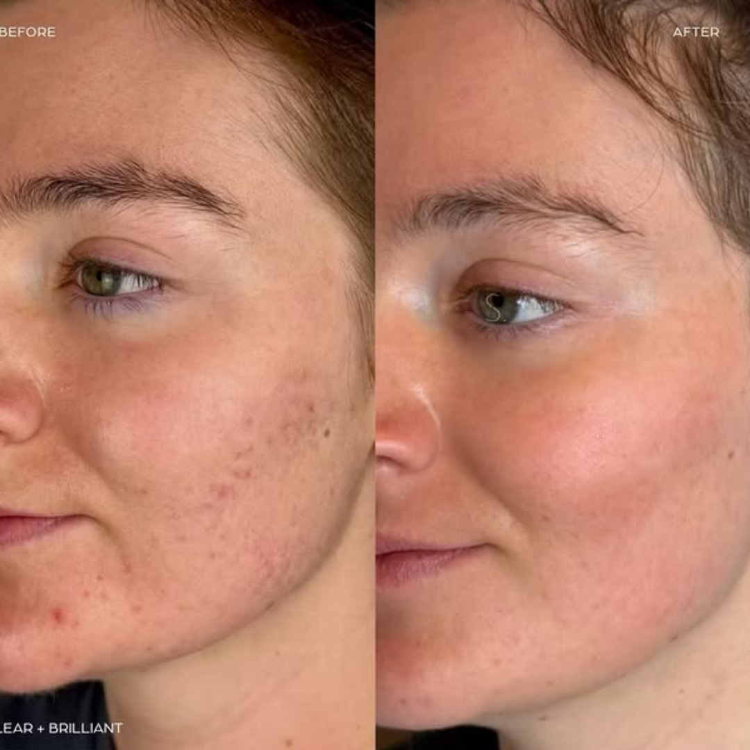 L'Oreal pink Exfoliating Peel | Facial Like Glow in Just 15 minutes | Anti dark spot, Pore minimizing, Brighten Skin tone