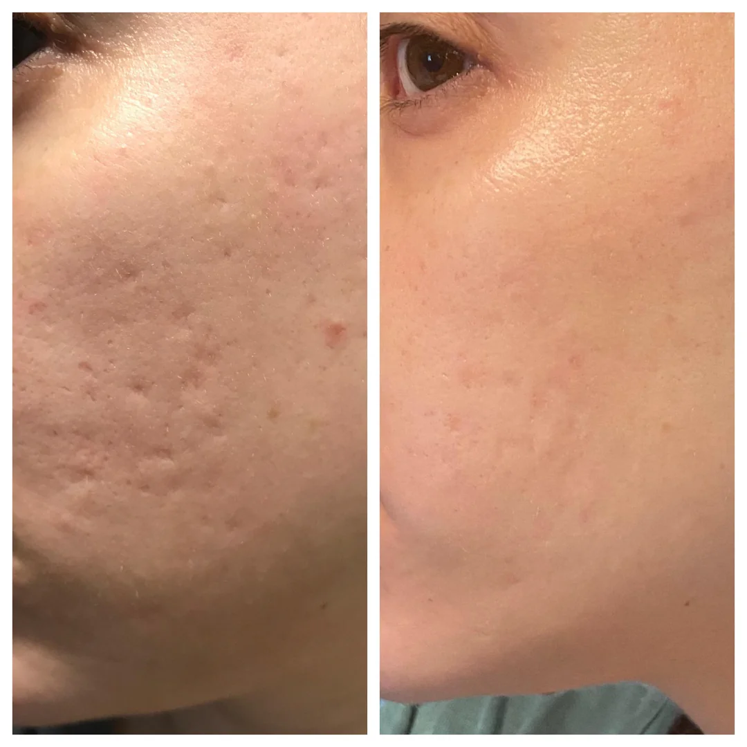 Laniska Scar Soothing Cream | 7-in-1 Skin Repair with Argan Oil, Shea Butter, Vitamin E & Hyaluronic Acid | Fades Scars, Warts & Scratches, Deep Hydration