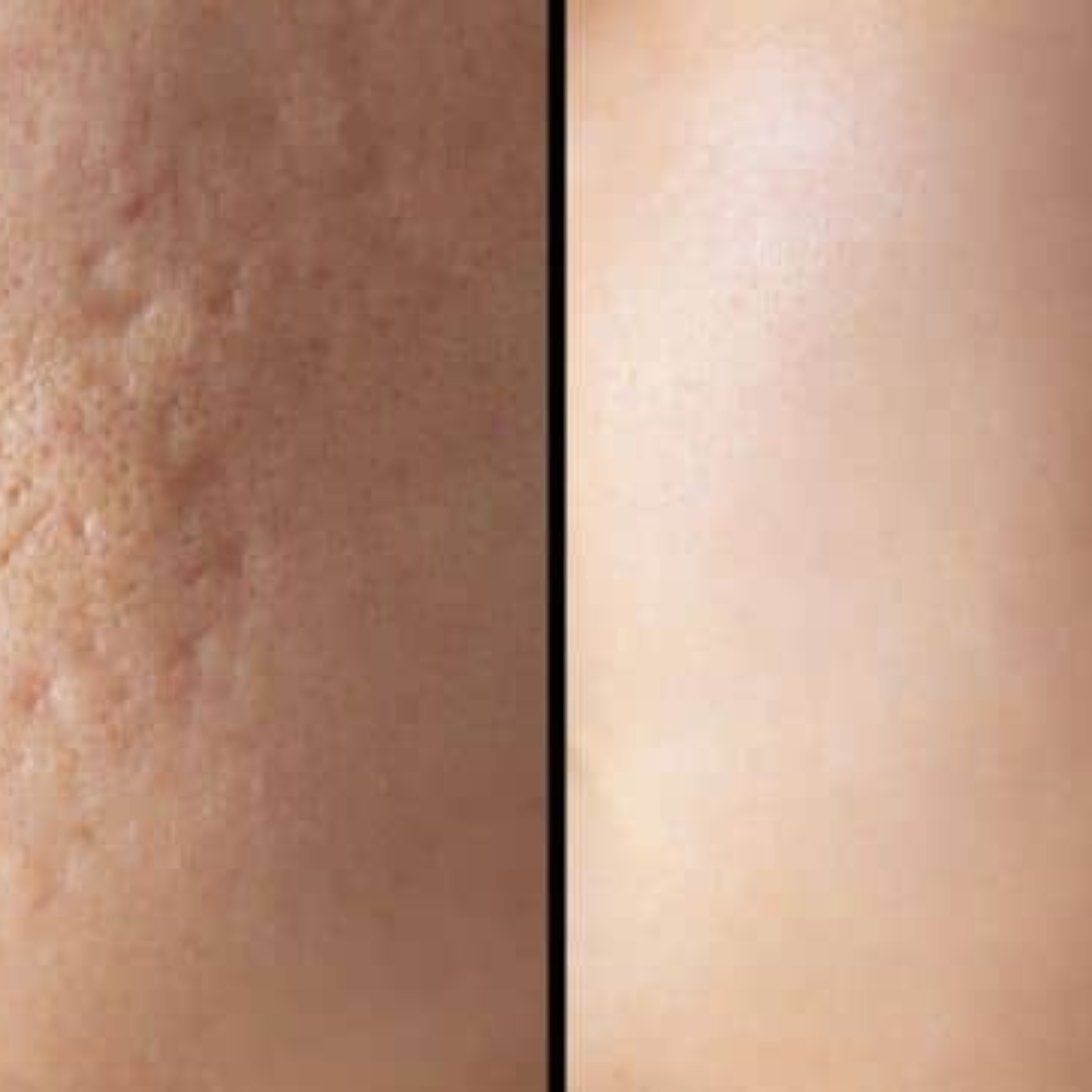Hakim Suleman's Stretch Mark & Scar Removal Cream | Enriched with Almond, Olive & Sandalwood Oil | Reduces Stretch Marks, Scars & Improves Skin Elasticity