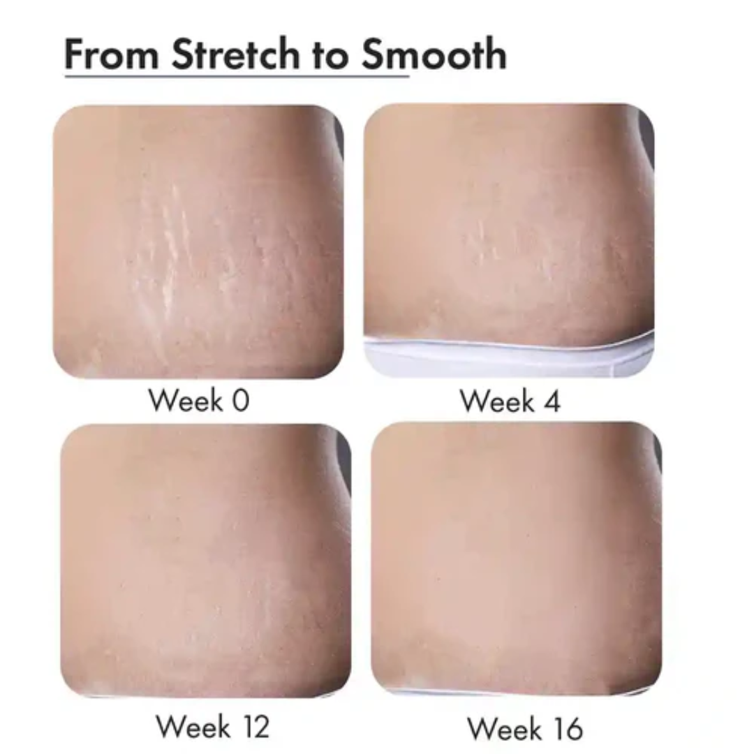 Hakim Suleman's Stretch Mark & Scar Removal Cream | Enriched with Almond, Olive & Sandalwood Oil | Reduces Stretch Marks, Scars & Improves Skin Elasticity