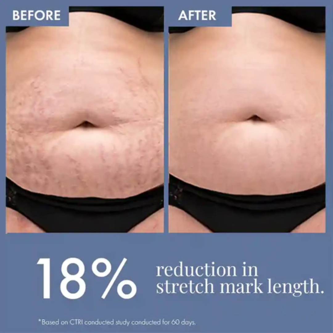 Hakim Suleman's Stretch Mark & Scar Removal Cream | Enriched with Almond, Olive & Sandalwood Oil | Reduces Stretch Marks, Scars & Improves Skin Elasticity