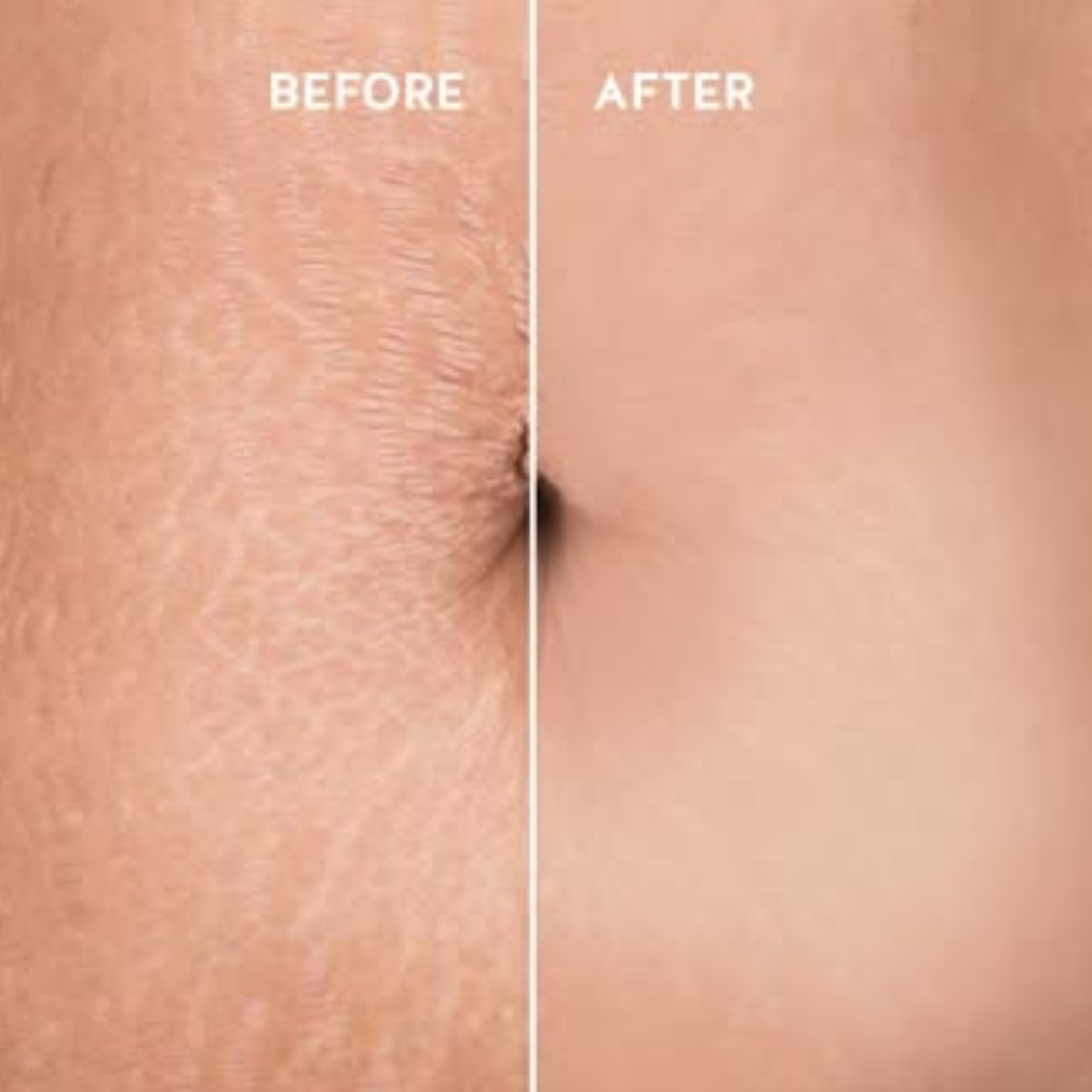 Ciara Liquid Serum for Stretch Marks | 6X Hyaluronic Acid + Squalane + Collagen | Fades Stretch Marks, Boosts Elasticity & Deep Skin Repair