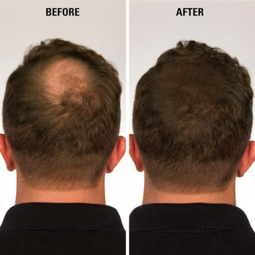 Tgideas Rosemary Amino Acid Shampoo – Strengthens Hair Roots, Promotes Hair Growth, Reduces Hair Fall – Deep Cleansing, Nourishing & Safe – For Dandruff, Oily Scalp, Dry & Frizzy Hair