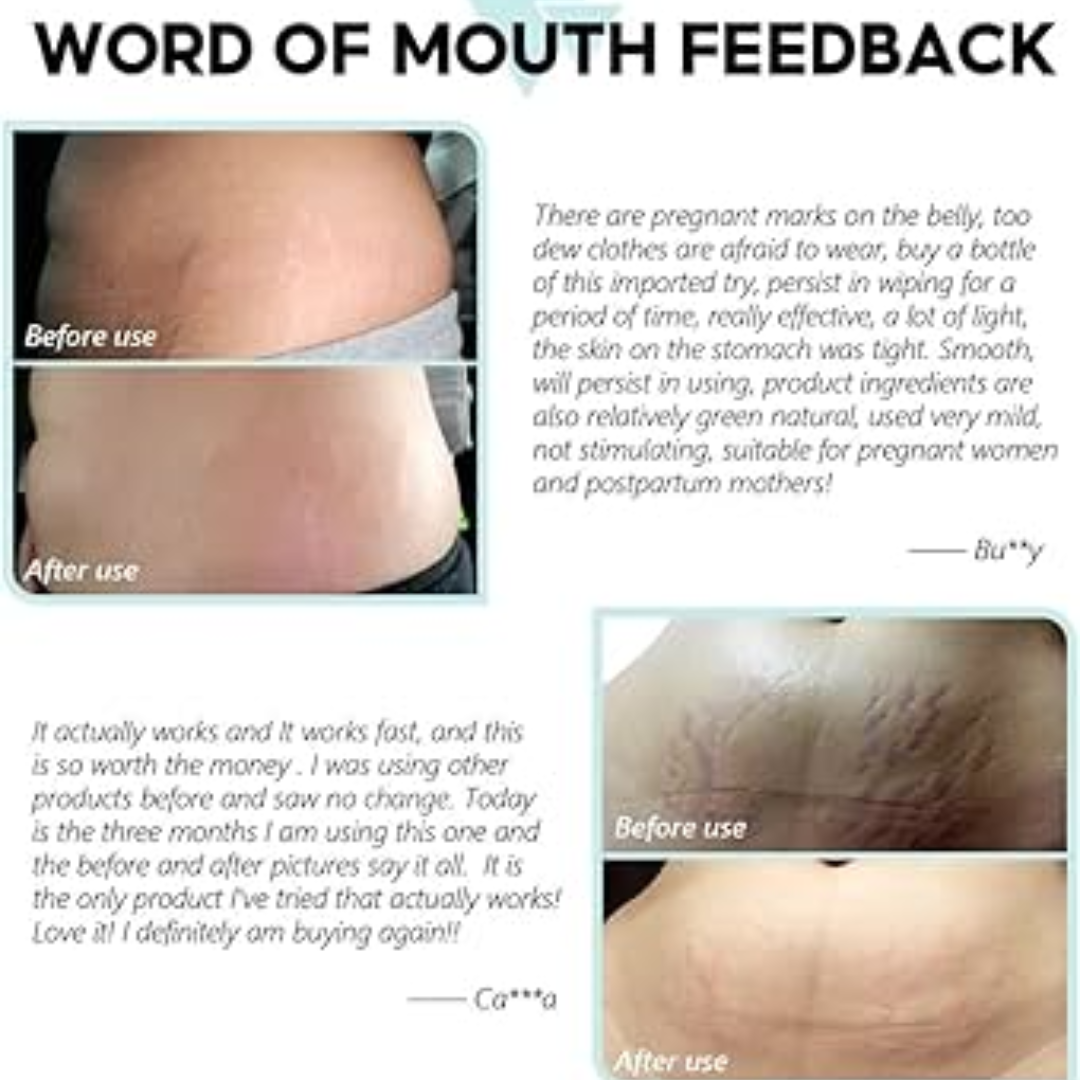 Hakim Suleman's Stretch Mark & Scar Removal Cream | Enriched with Almond, Olive & Sandalwood Oil | Reduces Stretch Marks, Scars & Improves Skin Elasticity